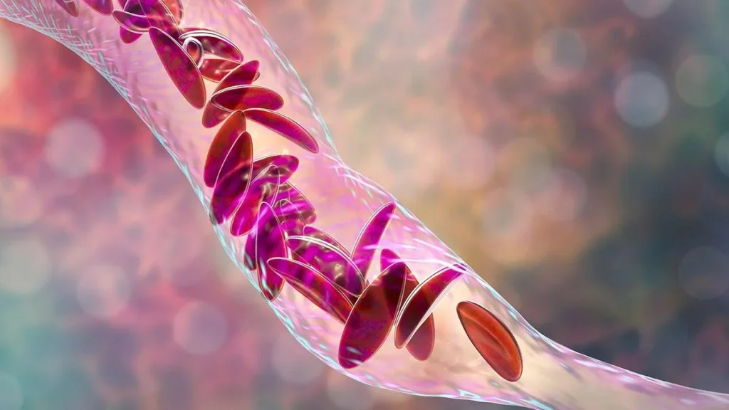 Experts stress early diagnosis and identifying underlying cause of anaemia