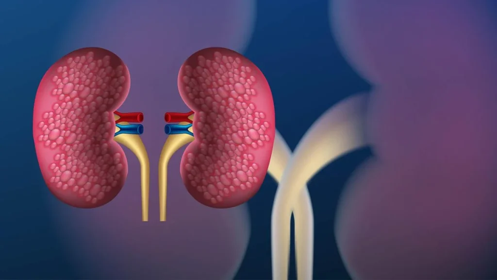 Nearly half of 844 million chronic kidney disease cases remain undiagnosed