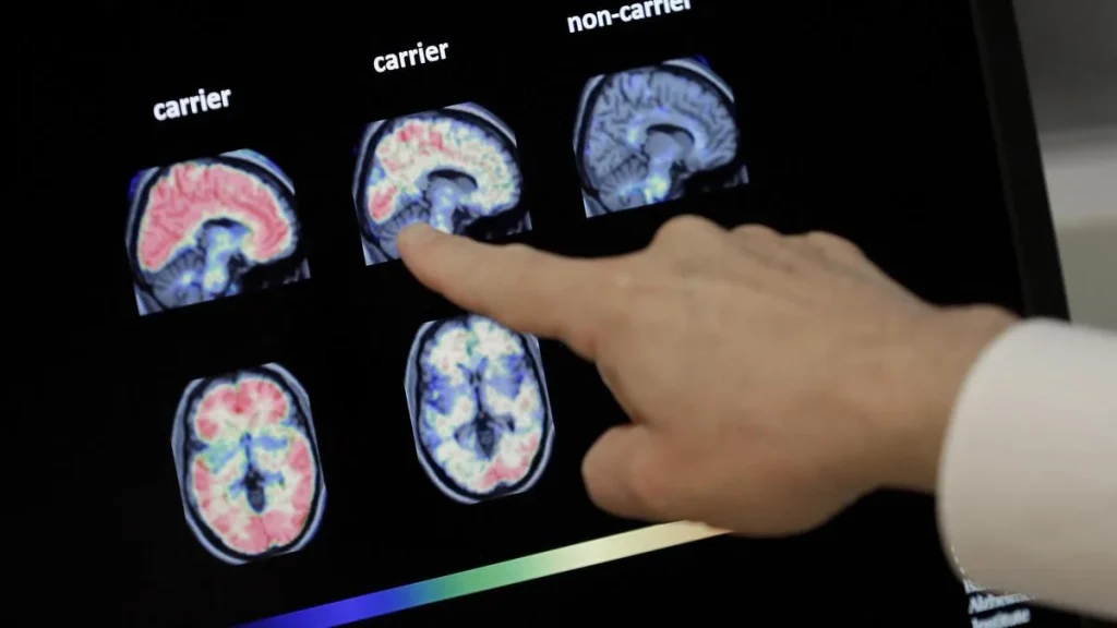 Diabetes, hearing loss among key factors for dementia in India; women more prone to