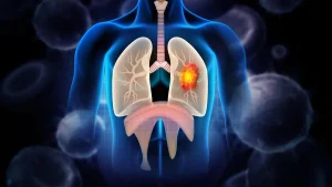 Lung cancer accounts for 6% of cancer cases in Karnataka; tobacco remains biggest