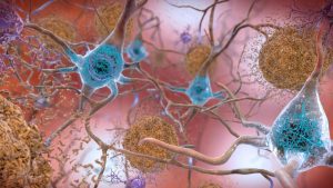 TB vaccine offers clue to retrain immune system against Alzheimer's