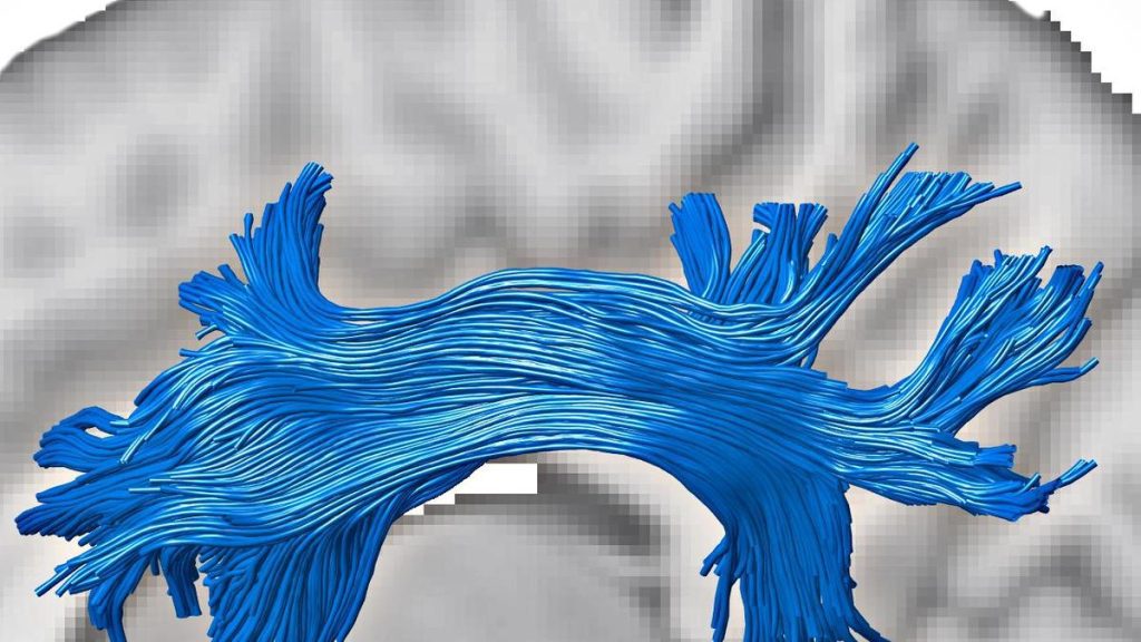 The study is among the first to examine the brain's superficial white matter in a community-based