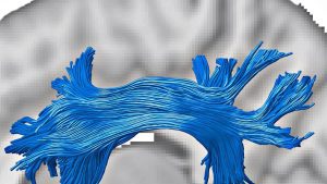The study is among the first to examine the brain's superficial white matter in a community-based
