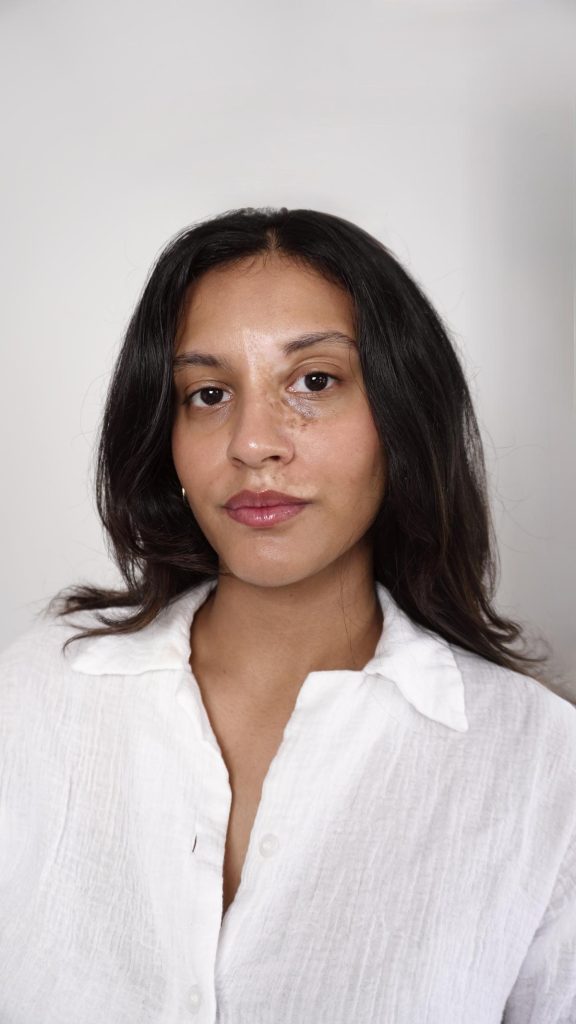 Understanding vitiligo