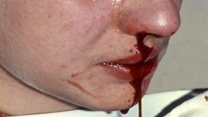 key details about: nosebleeds