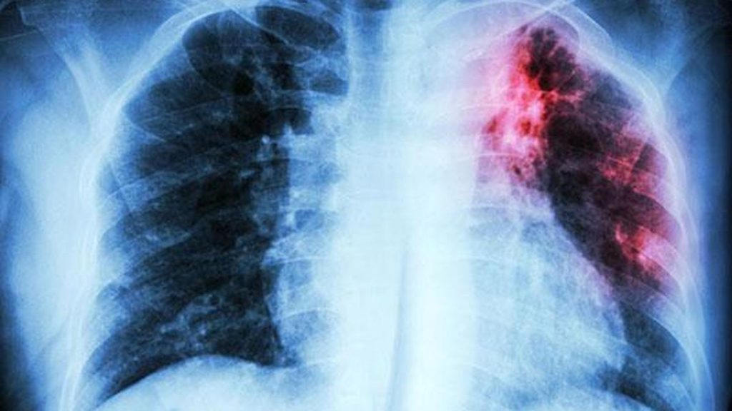 Findings published in The Lancet Respiratory Medicine show that tuberculosis preventive