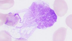 Chronic lymphocytic leukemia (CLL) is a type of leukemia or blood cancer that affects the blood