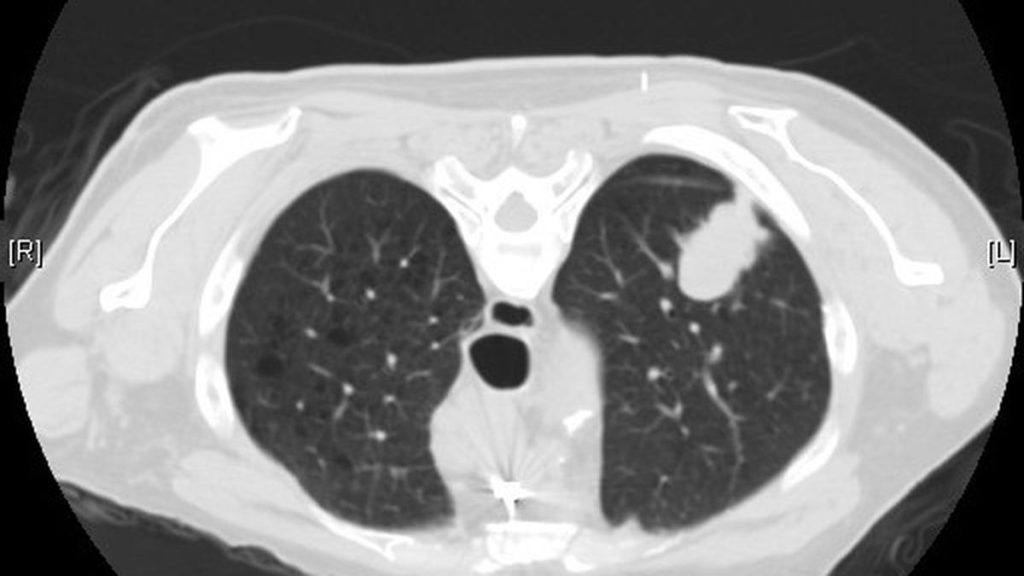 Not all cases of lung adenocarcinoma can be prevented, but reducing exposure to known risk