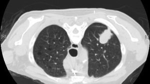 Not all cases of lung adenocarcinoma can be prevented, but reducing exposure to known risk