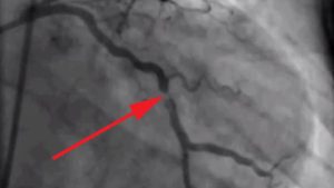What is coronary thrombosis? Explained