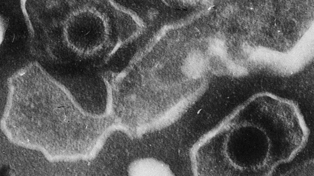 Epstein-Barr virus (EBV) is among the most widespread of human viruses