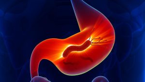 If the infection persists for many years, it can cause chronic inflammation in the stomach